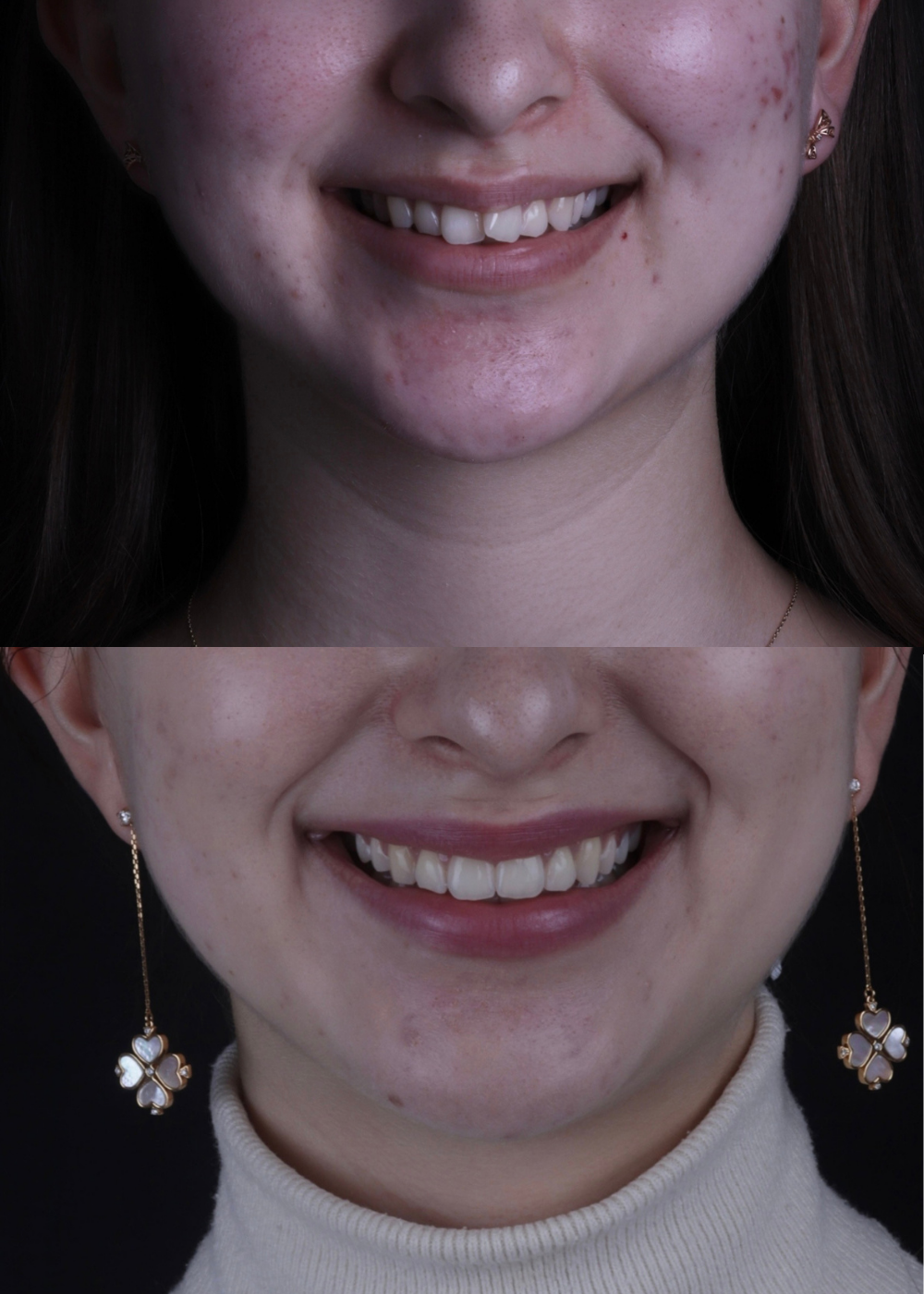 Invisalign clear aligners at St James Dental Surgery in Muswell Hill