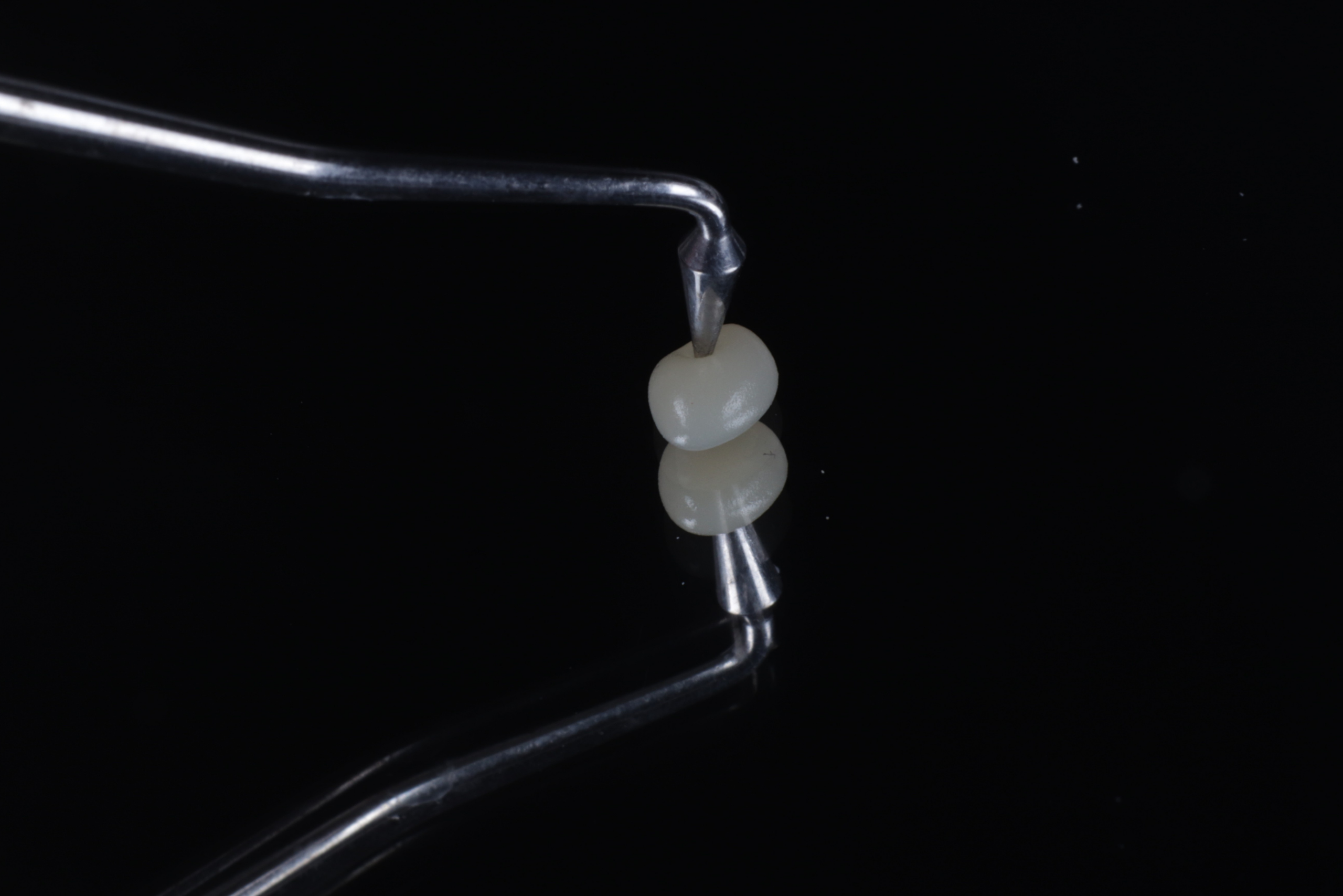 Onlay restoration at St James Dental Surgery in Muswell Hill