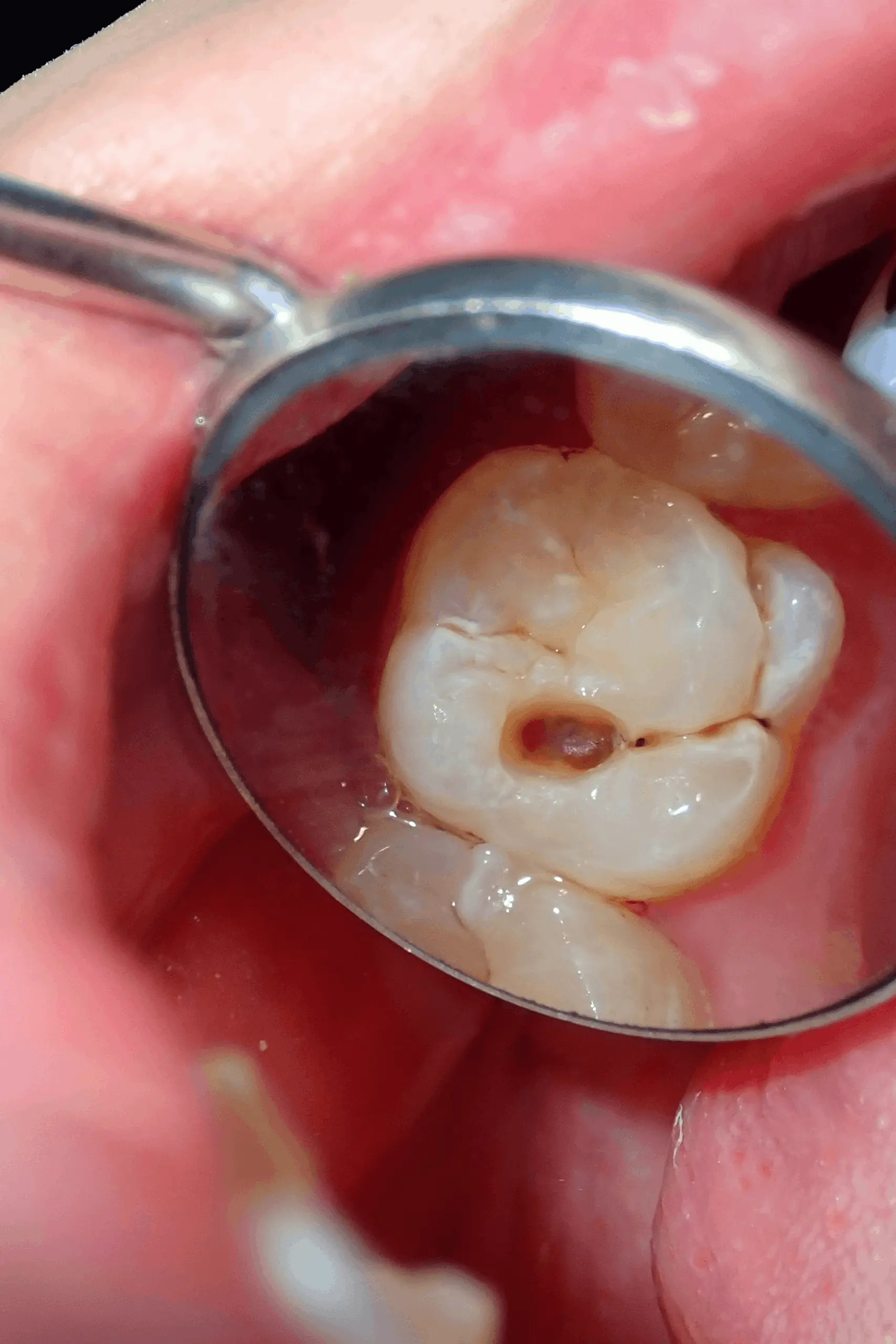 Tooth decay requiring a dental filling