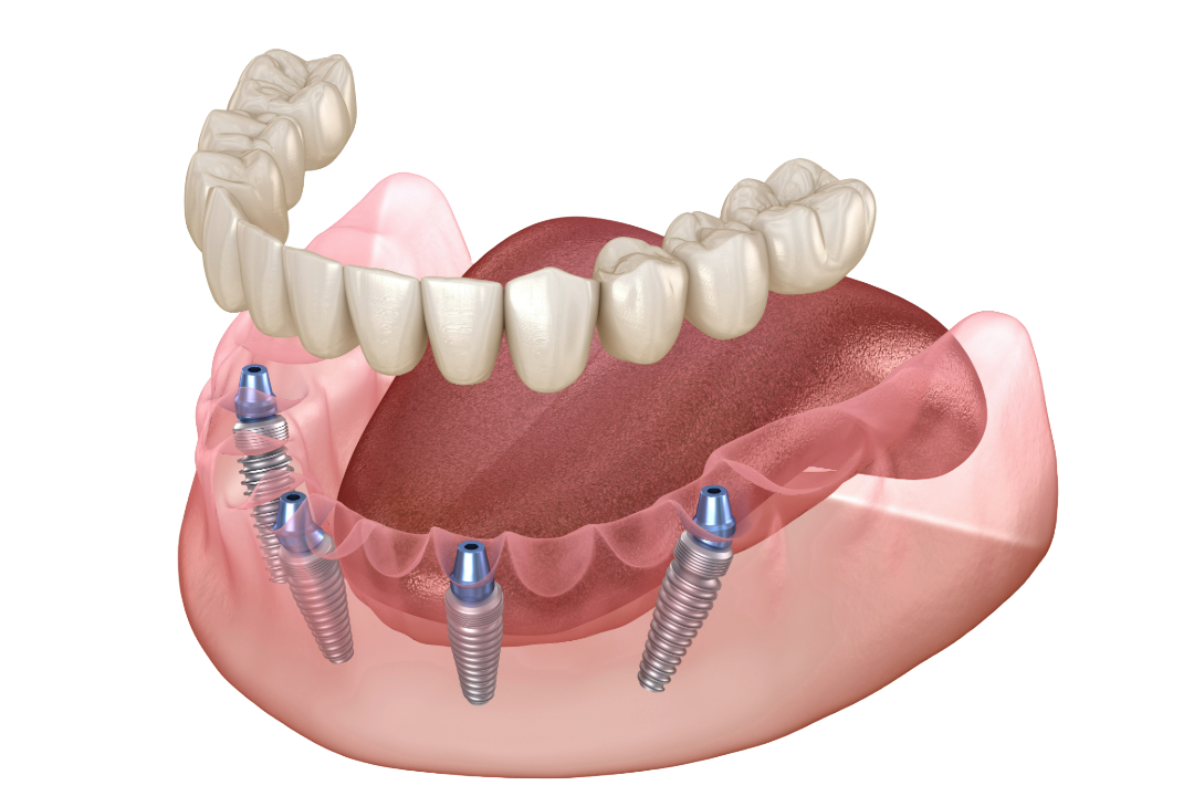 All-on-4 dental implant diagram showing four implants supporting a full arch