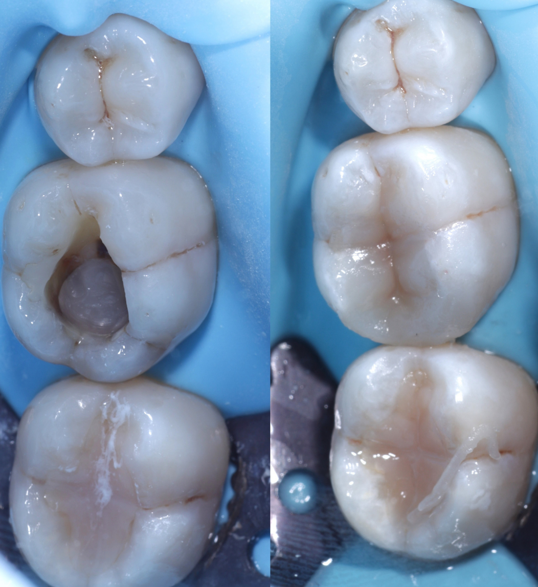 Biomimetic dentistry before and after