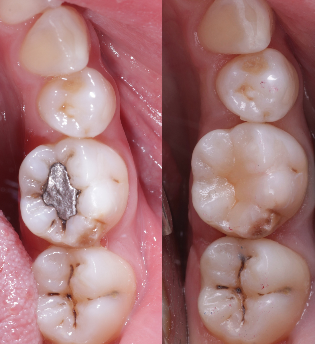 Biomimetic dentistry before and after