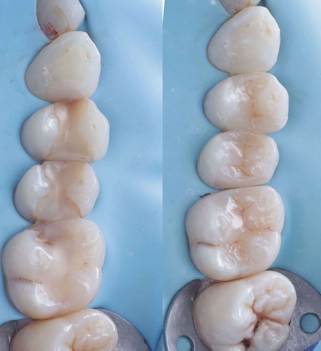 Biomimetic dentistry before and after, case two