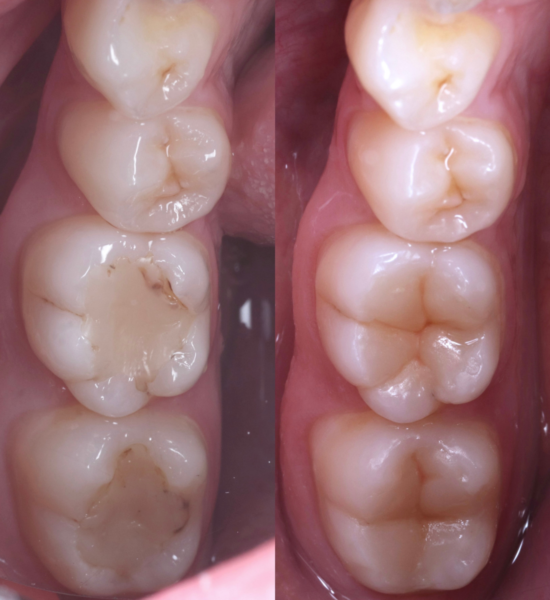 Biomimetic dentistry before and after