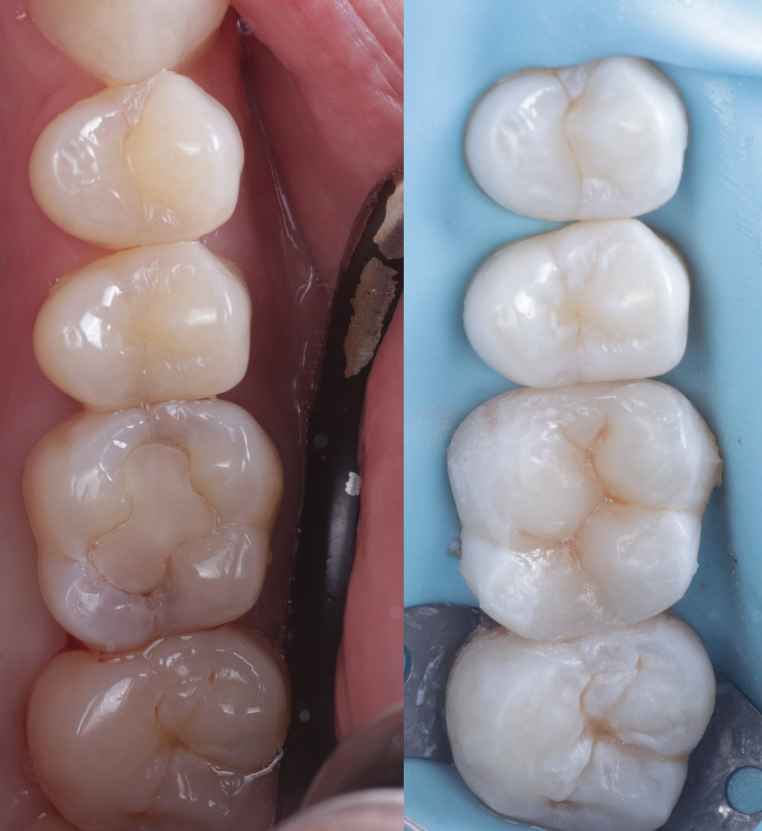 Biomimetic dentistry before and after, case five