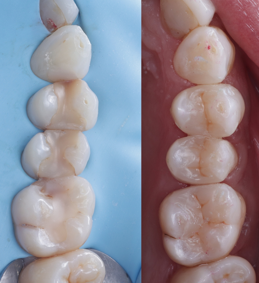 Biomimetic dentistry before and after