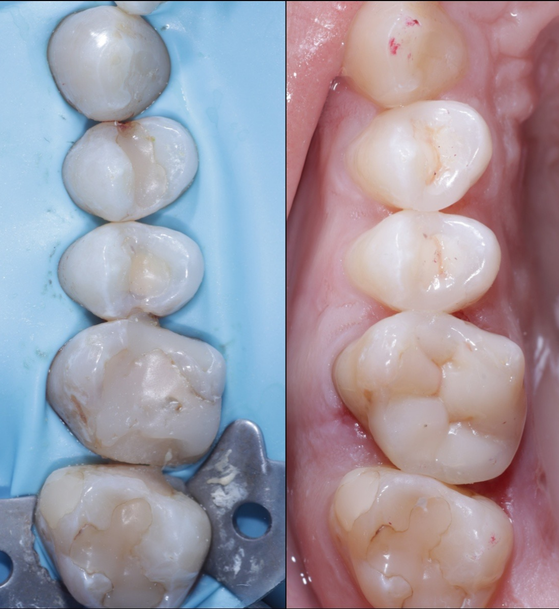 Biomimetic dentistry before and after, case seven