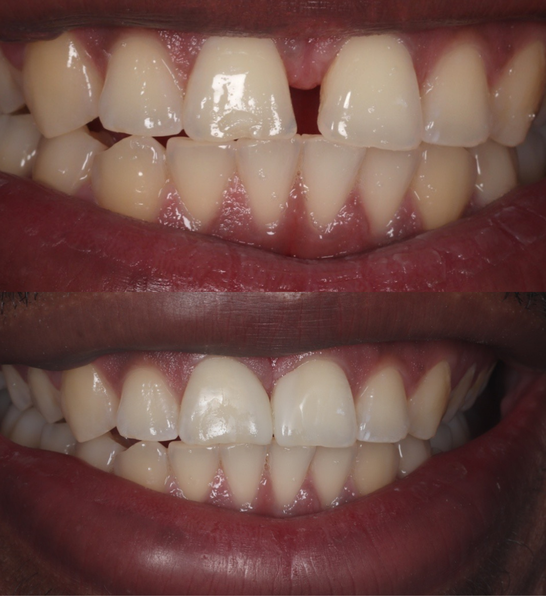 Composite bonding before and after, case three