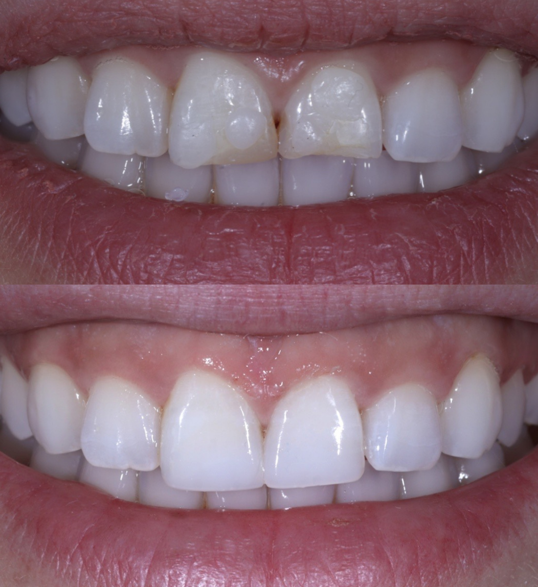 Composite bonding before and after, case seven