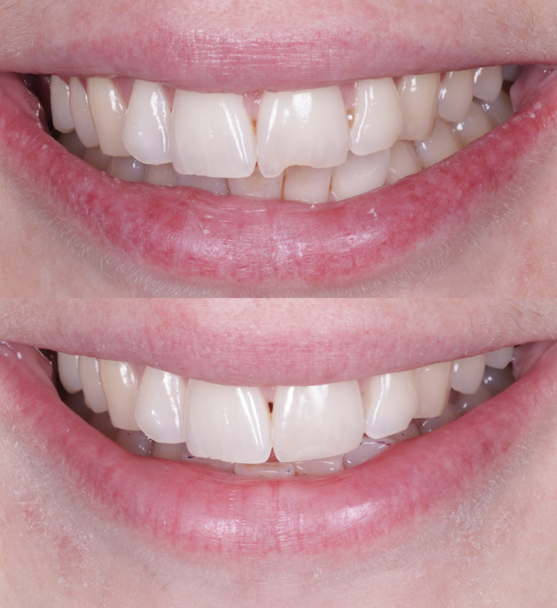 Composite bonding before and after