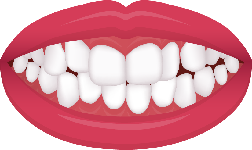 Crowding illustration