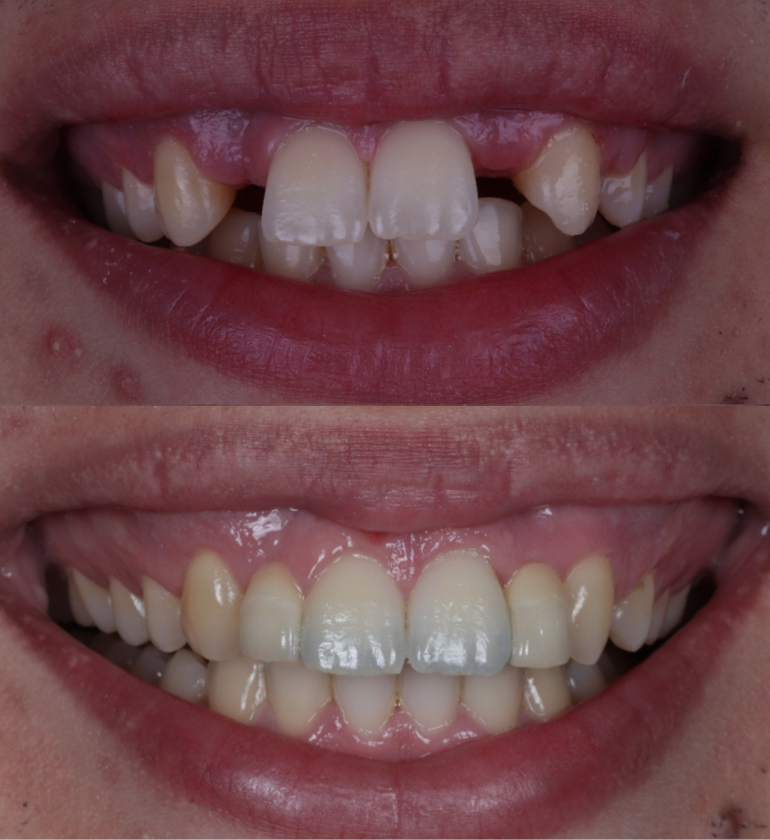 Dental bridge before and after