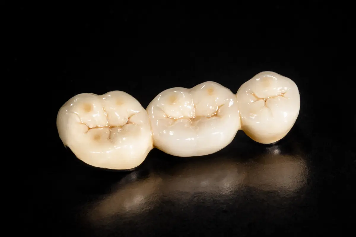 Dental bridge treatment at St James Dental Surgery in Muswell Hill