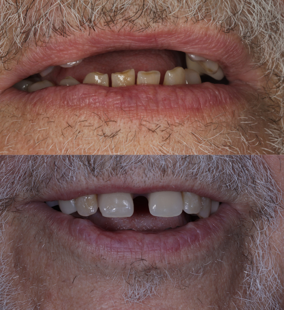 Dentures before and after