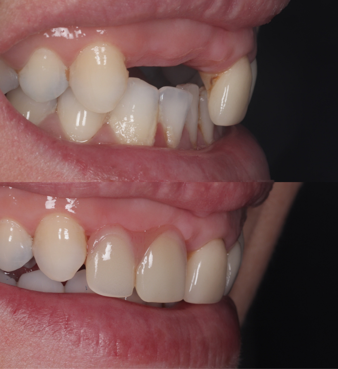 Dentures before and after