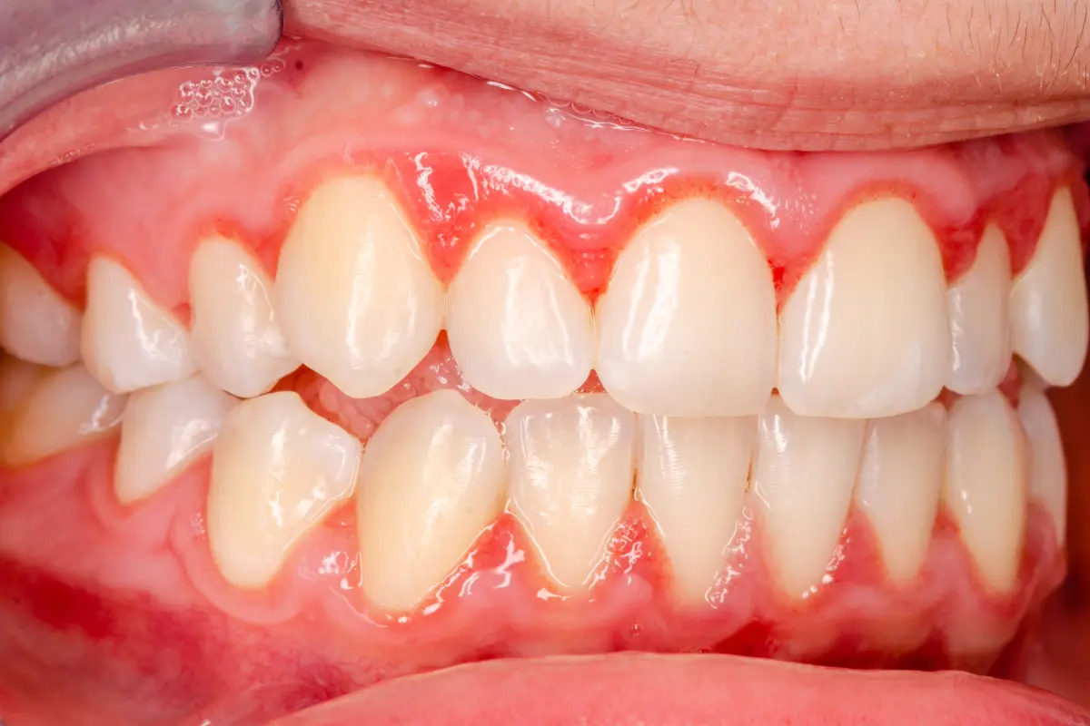 Illustration of gingivitis showing inflamed gums