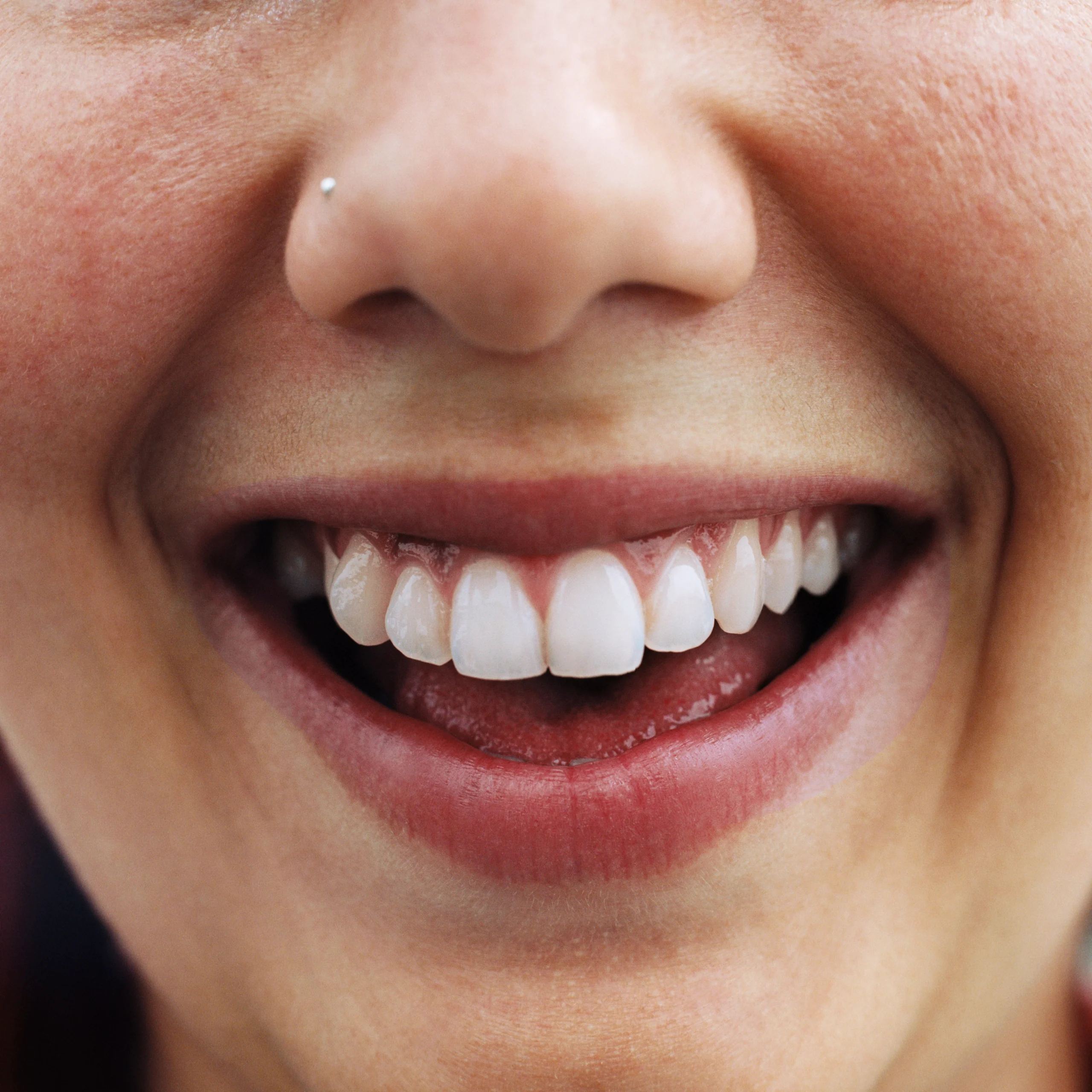 Gum treatment in Muswell Hill