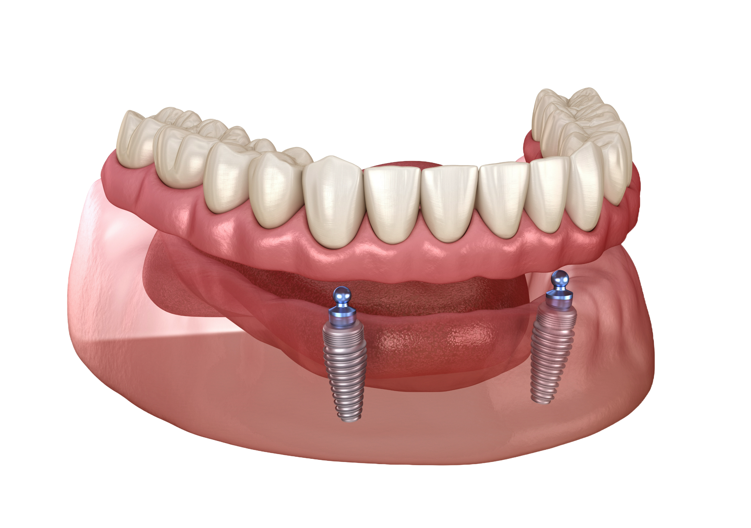 Implant-retained denture showing how it clips onto dental implants in the jaw