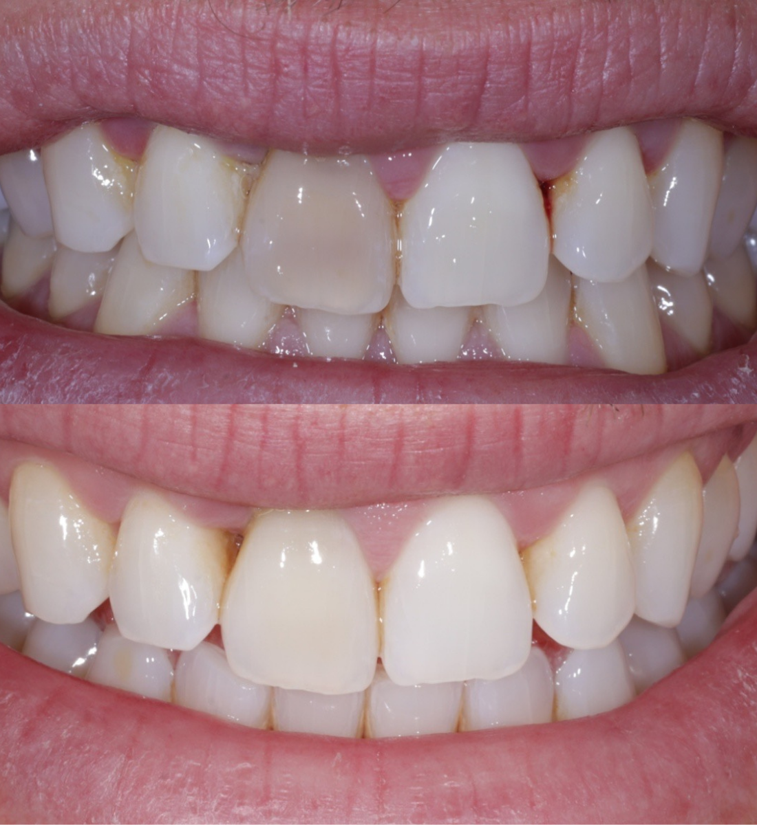 Internal whitening before and after