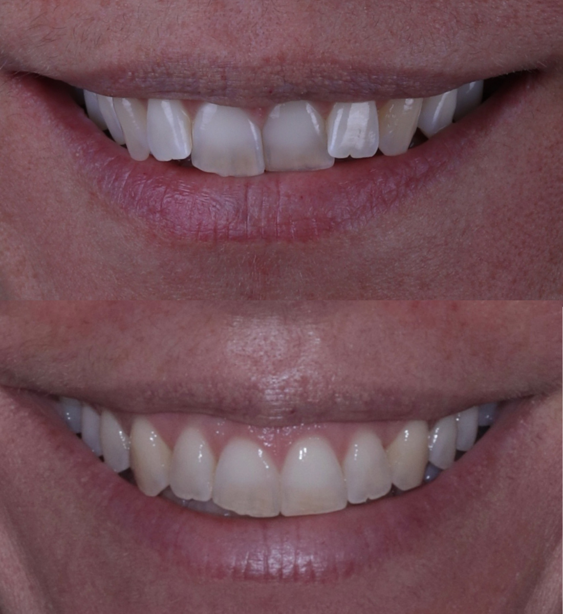 Invisalign before and after