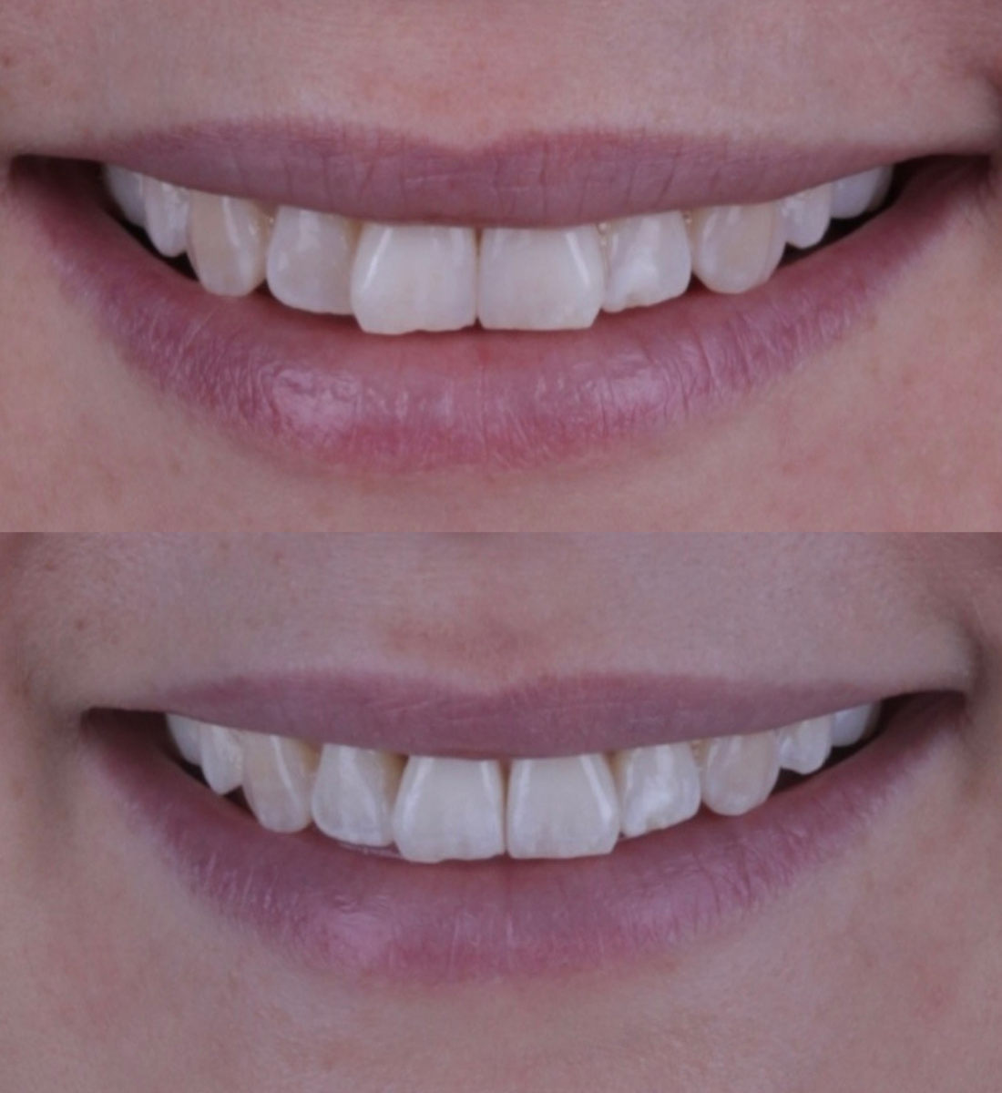Invisalign before and after