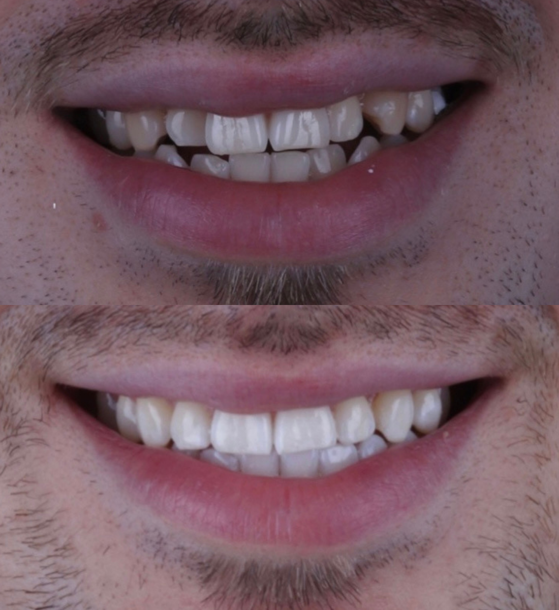 Invisalign before and after