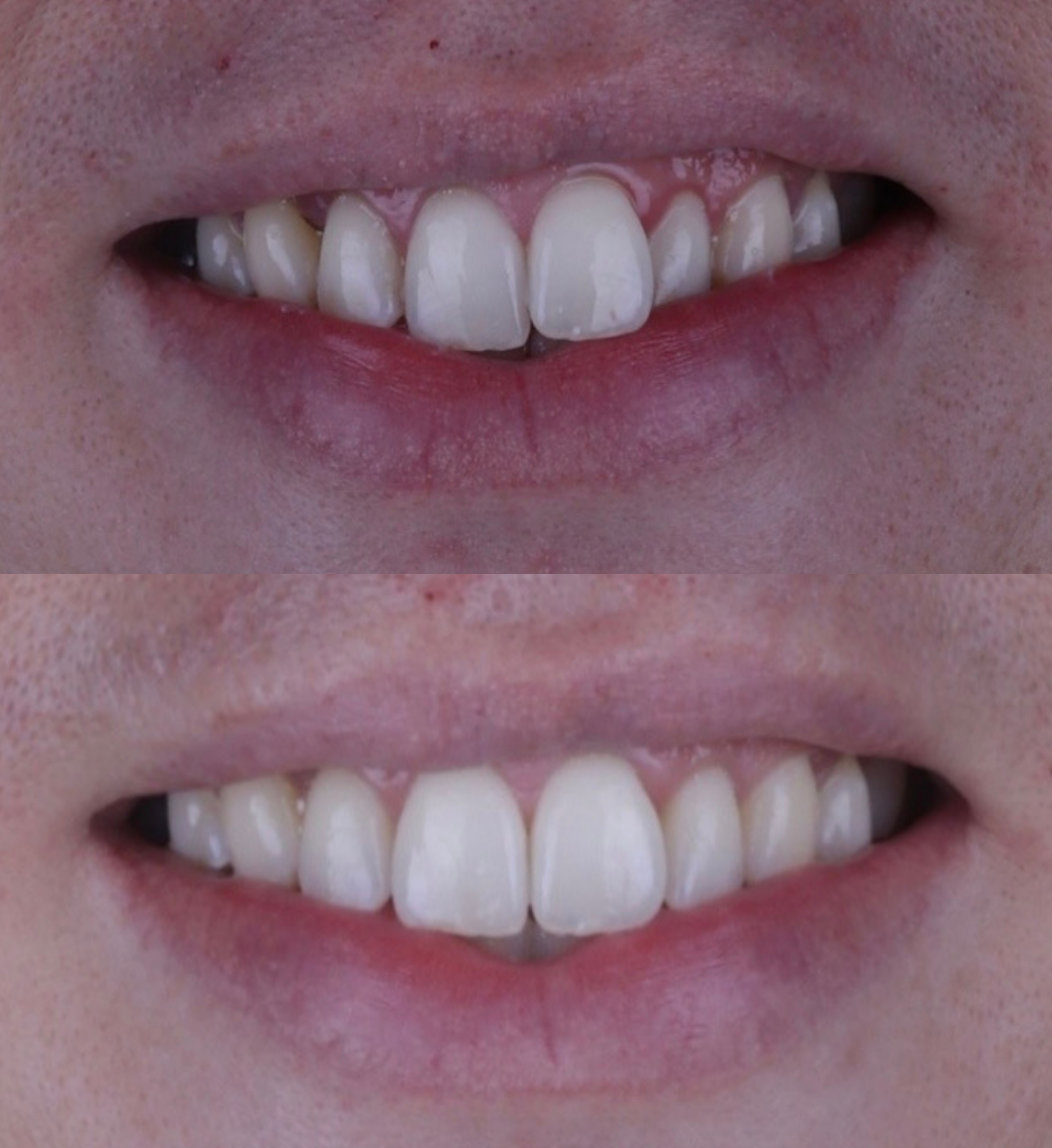 Invisalign before and after, case twelve