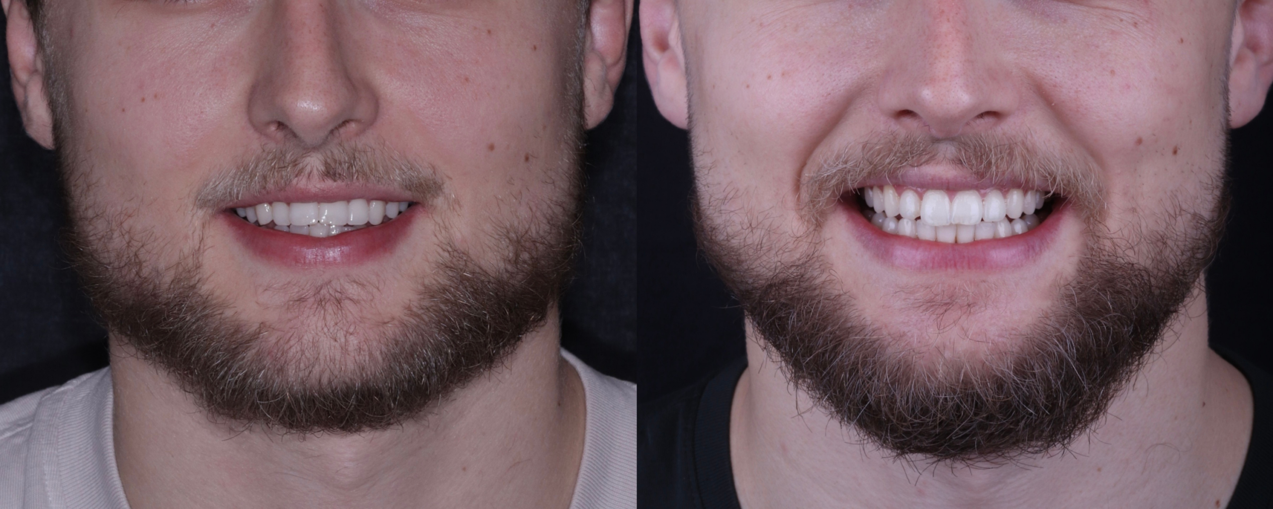 Invisalign before and after, case one