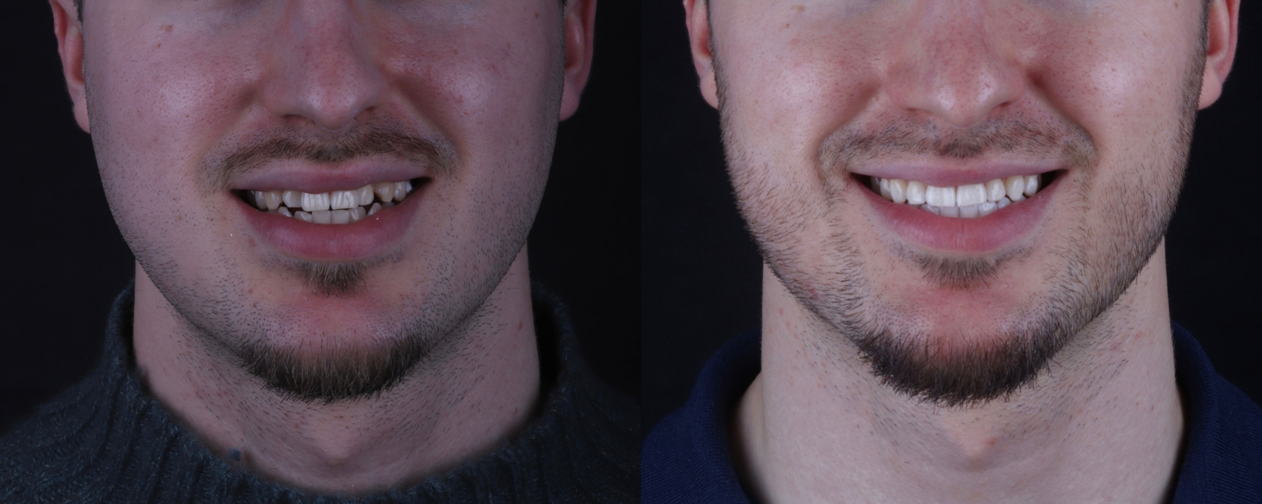 Invisalign before and after, case seven