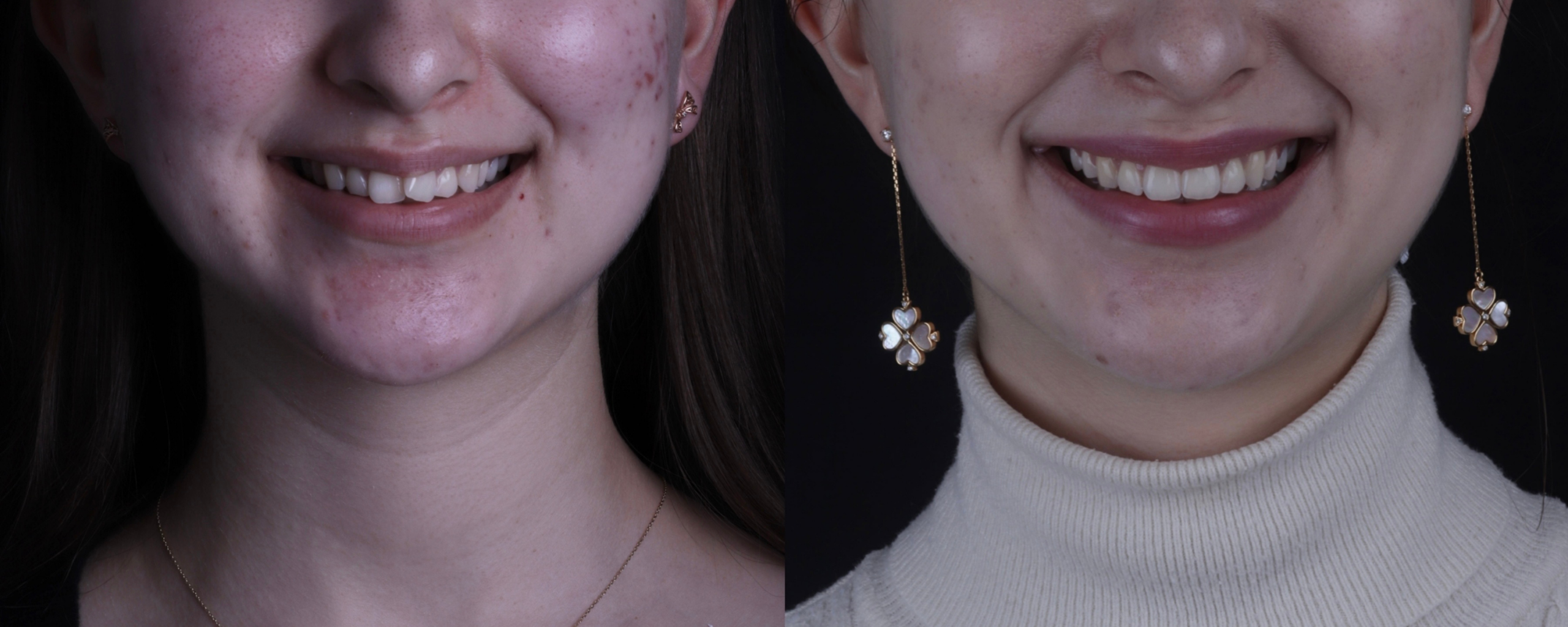 Invisalign before and after, case eleven