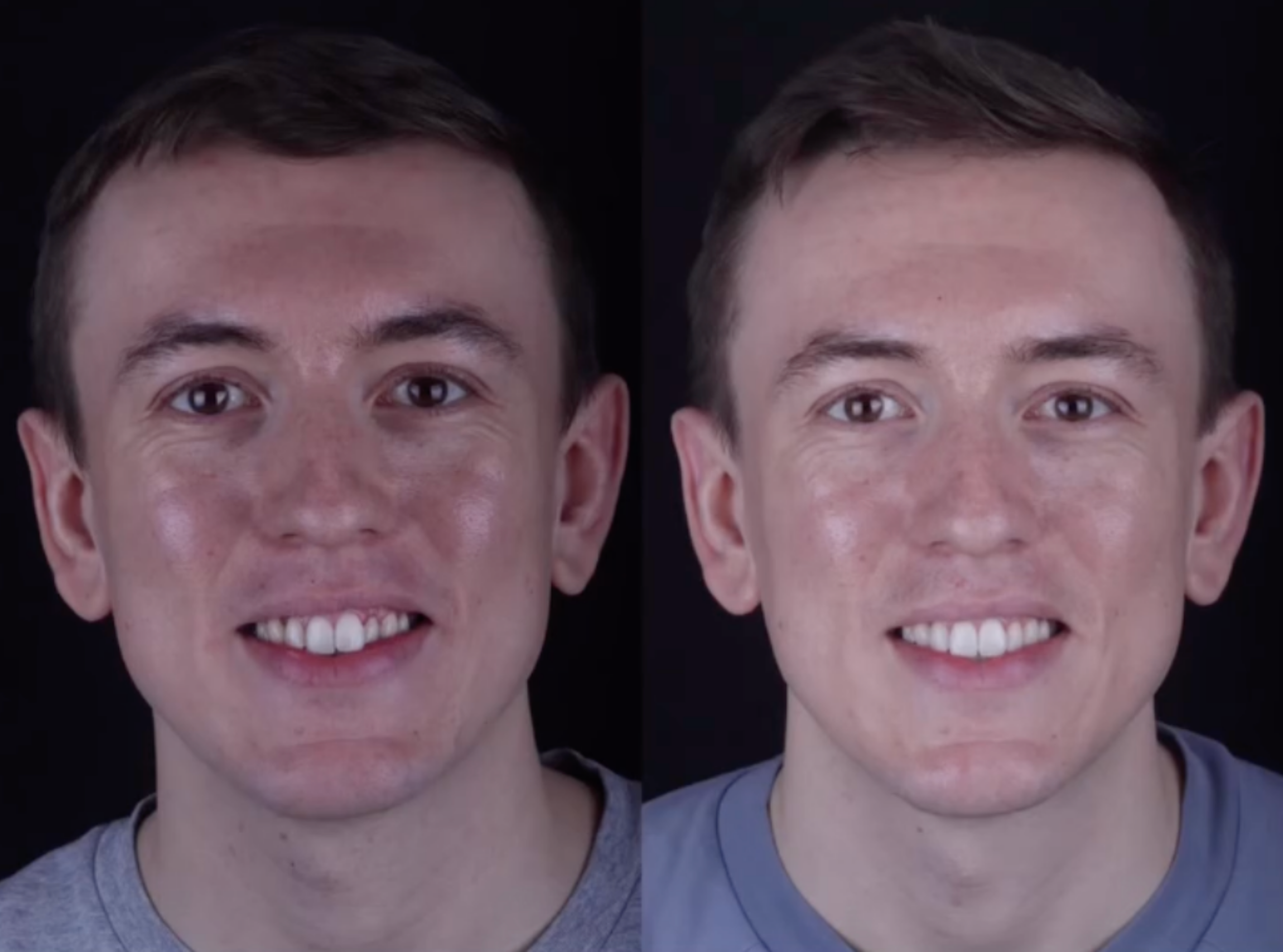 Invisalign before and after result at St James Dental Surgery