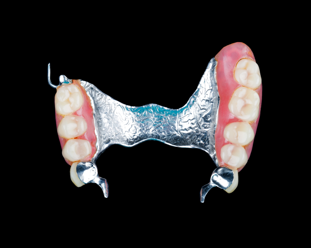 Partial metal-framed denture
