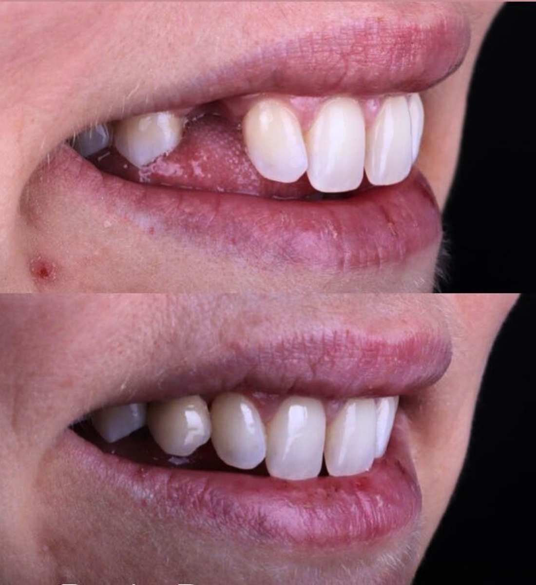 Dental bridge treatment at St James Dental Surgery in Muswell Hill