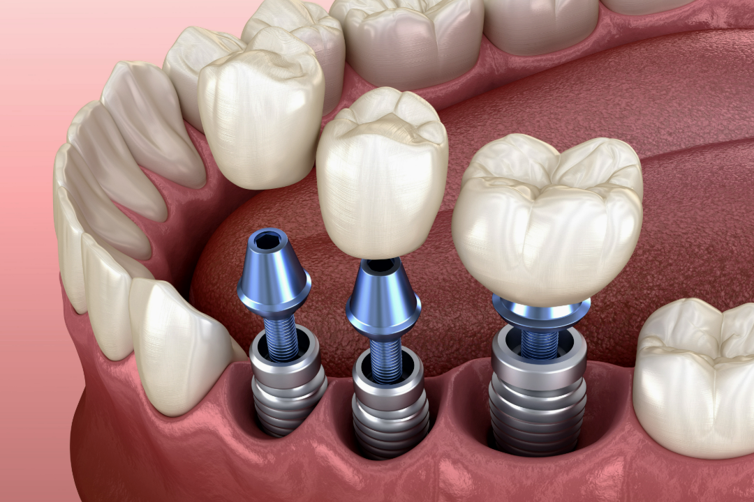 Implant-supported bridge replacing several teeth