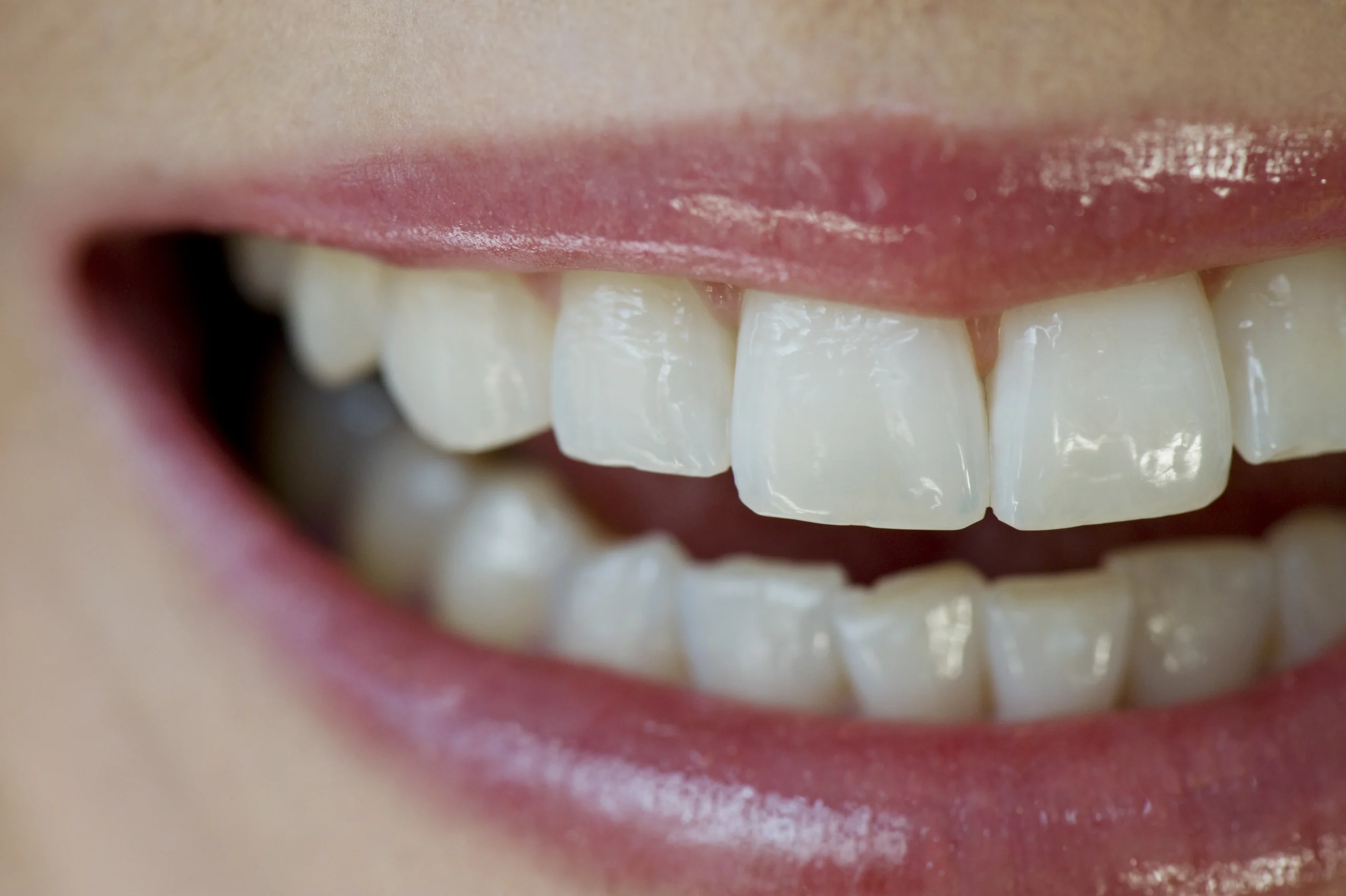 Composite bonding example