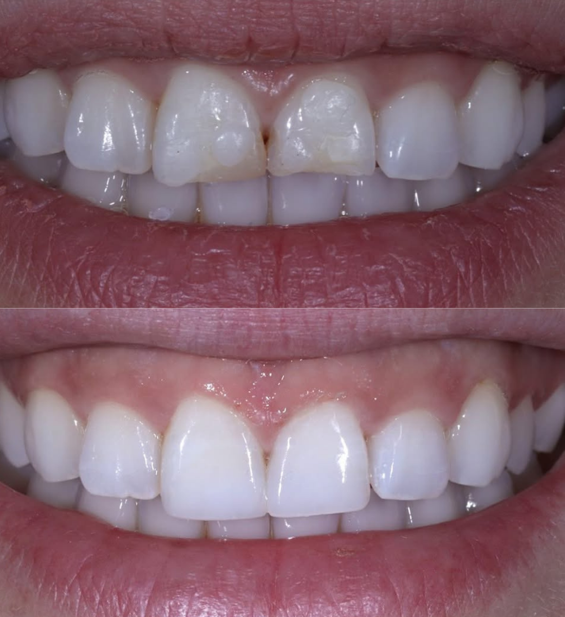 Teeth whitening and bonding before and after