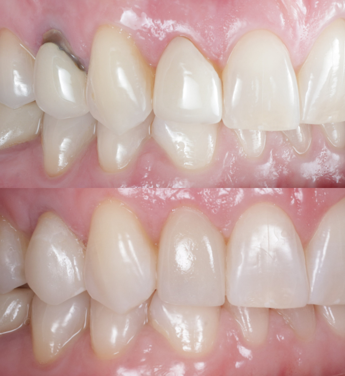 Veneers before and after, case eight