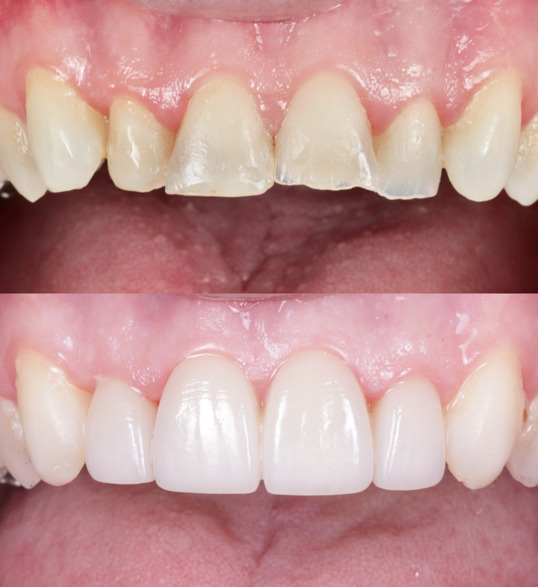 Veneers before and after, case seven