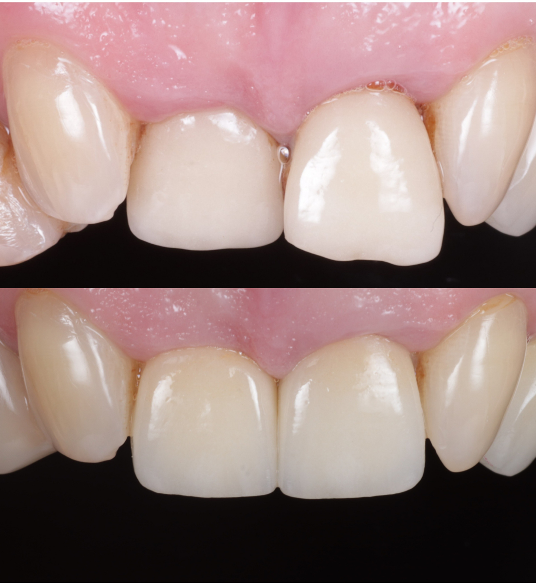 Veneers before and after, case five