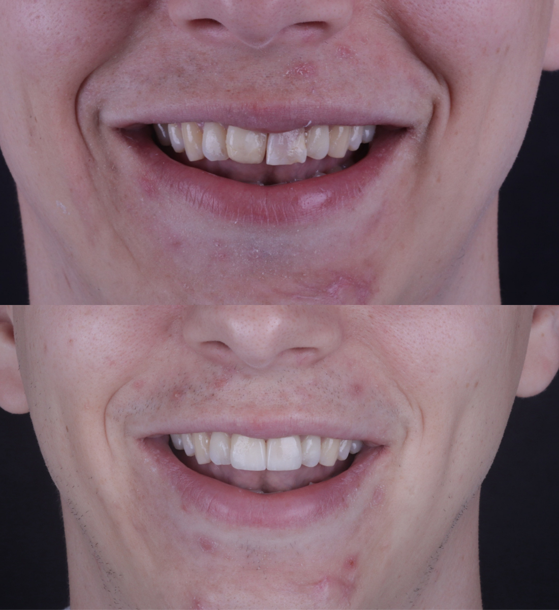 Veneers before and after
