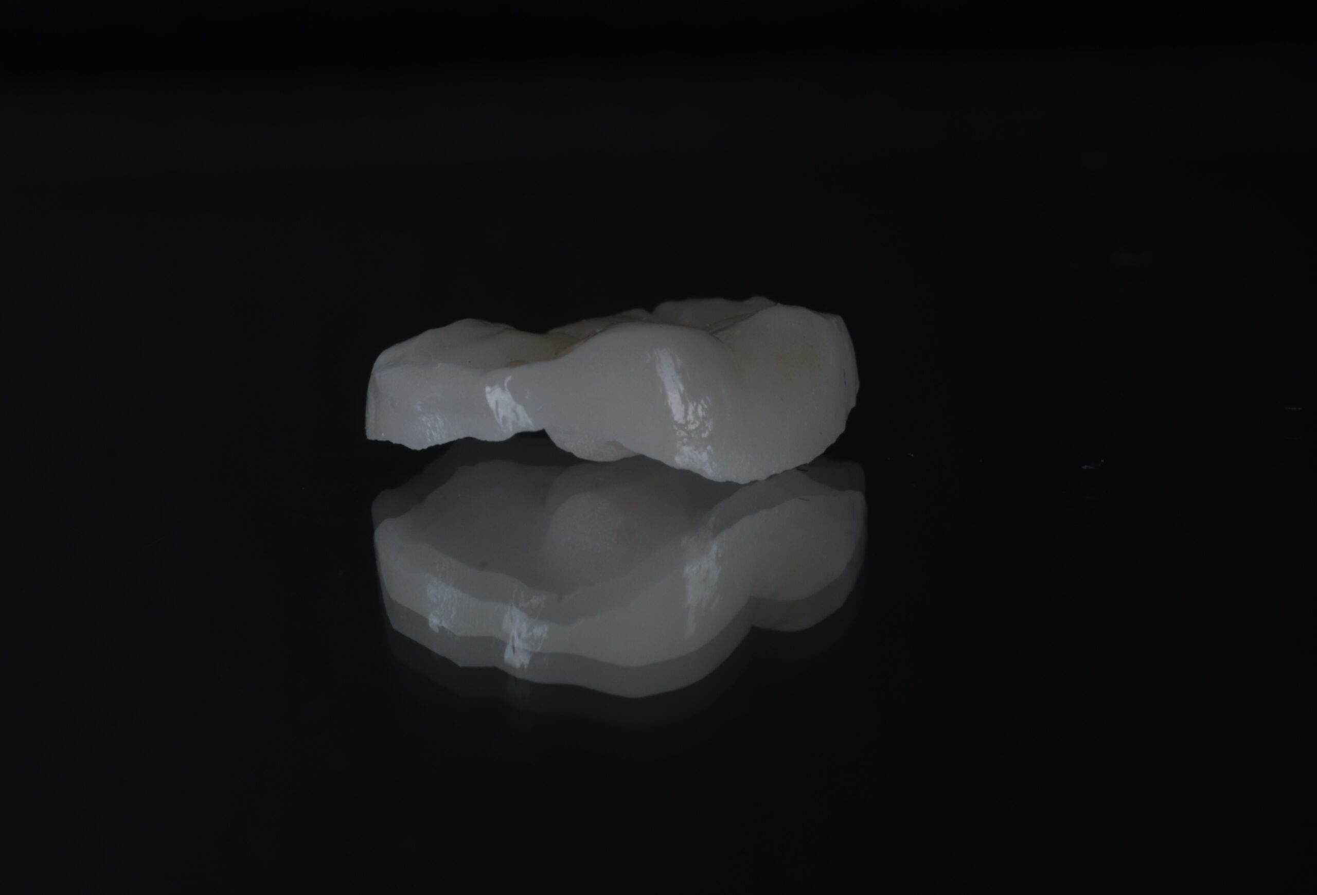 Dental onlay restoration