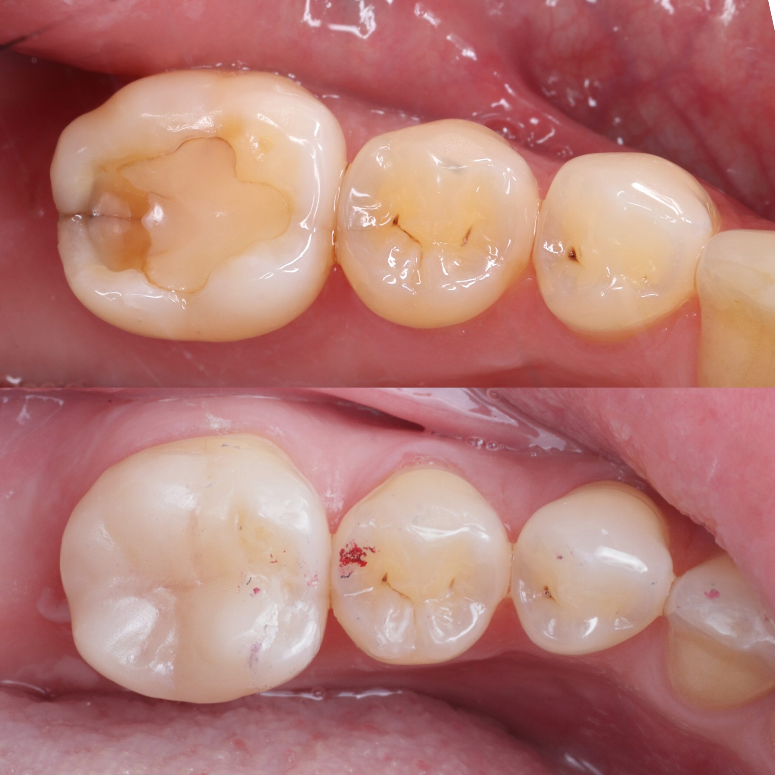 Onlay before and after, case four