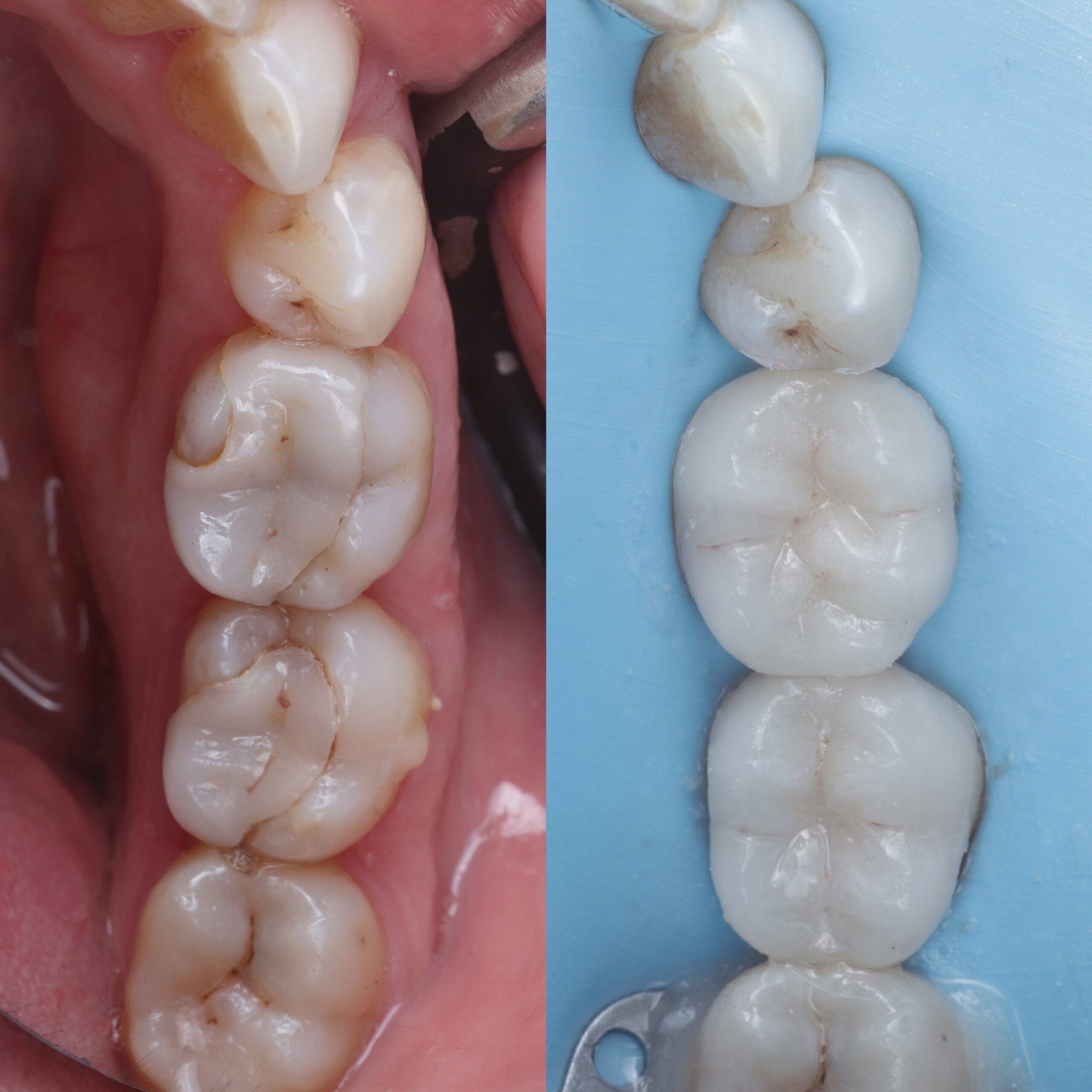 Onlay before and after, case three