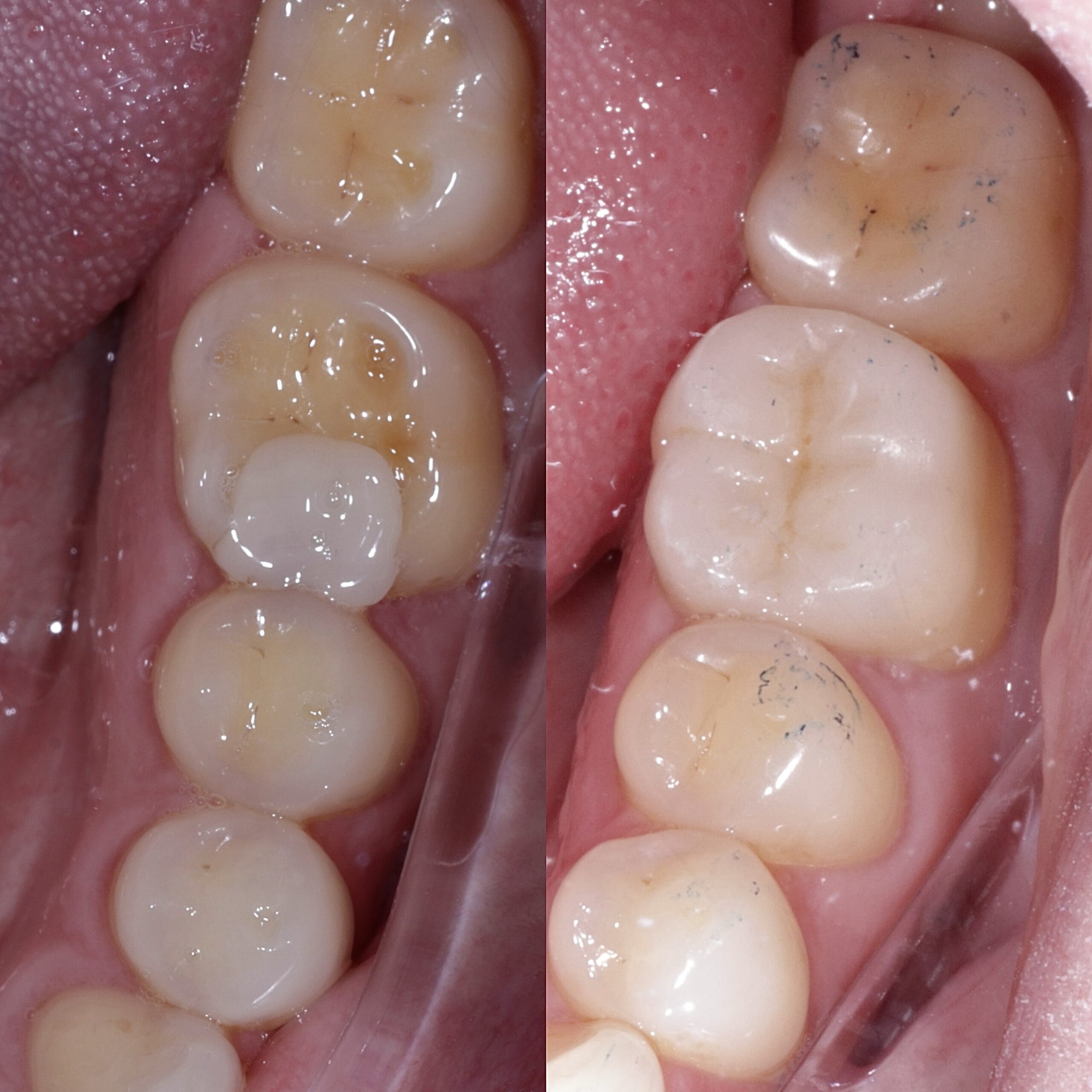 Onlay before and after, case two