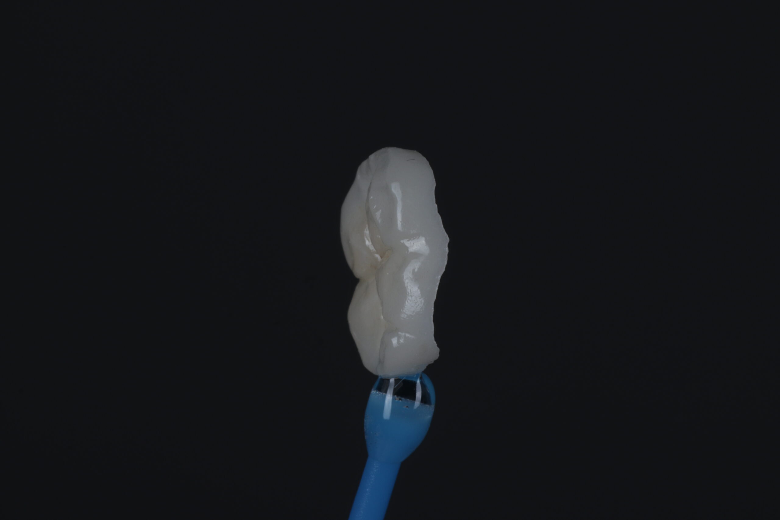 Onlay restoration at St James Dental Surgery in Muswell Hill