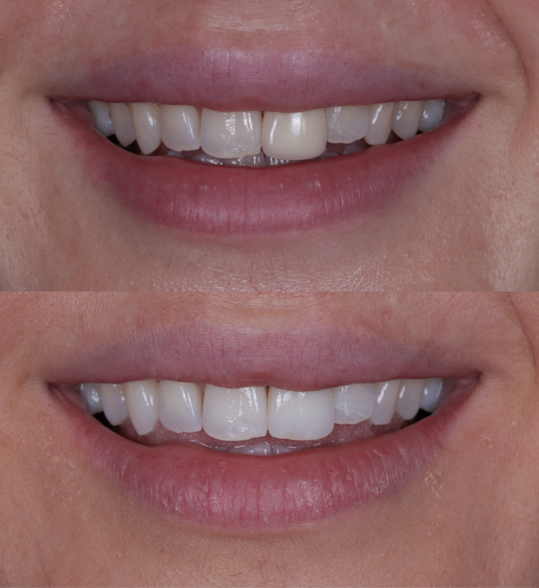Whitening before and after