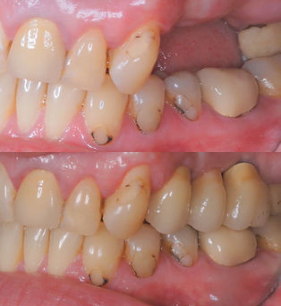 Multiple tooth dental implants before and after