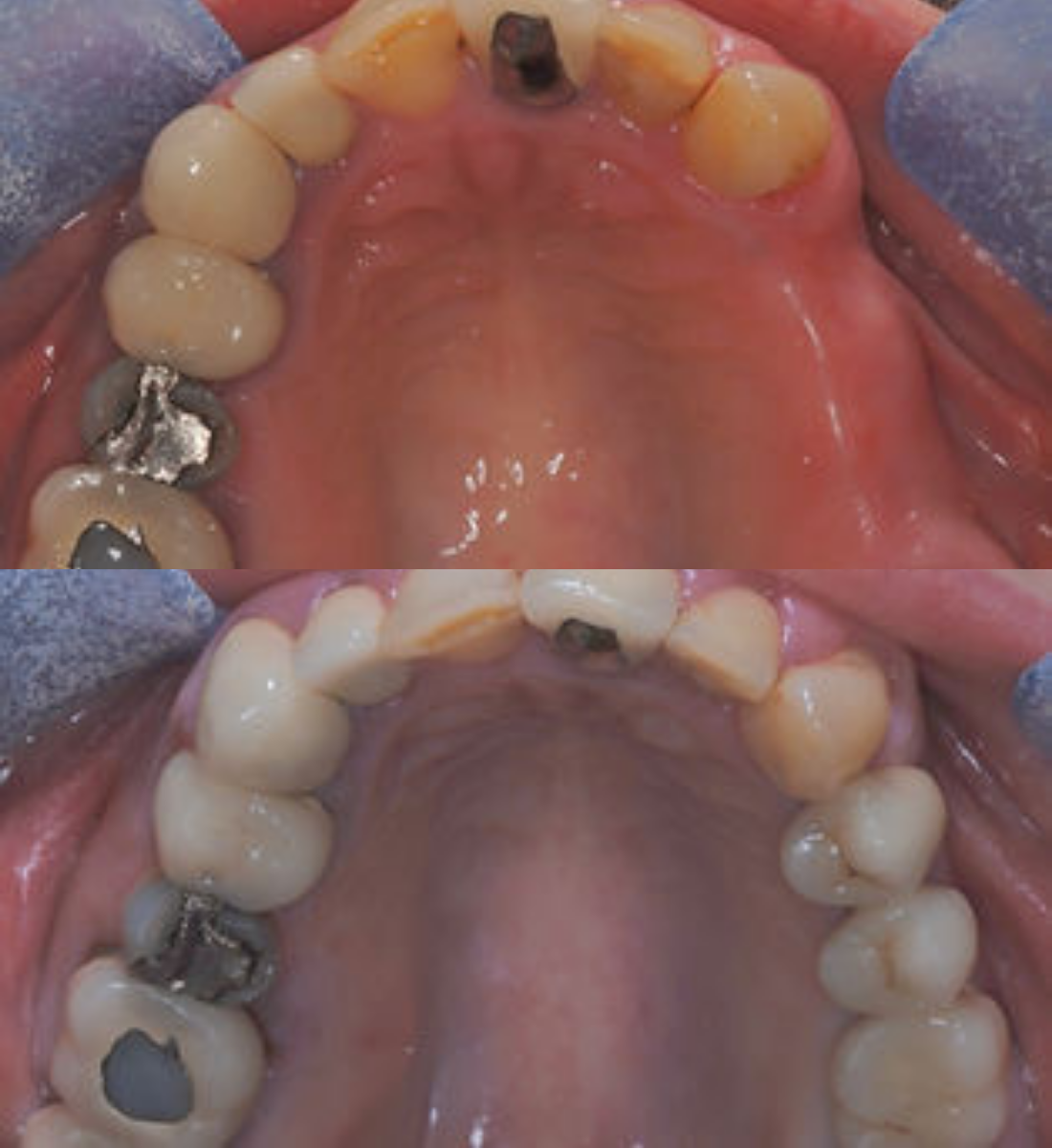 Multiple tooth dental implants before and after