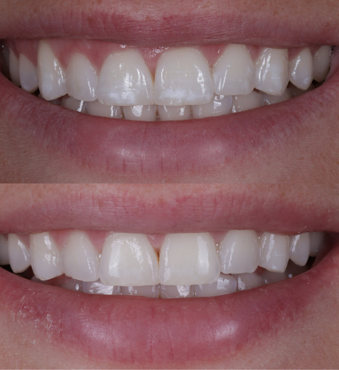 ICON treatment before and after