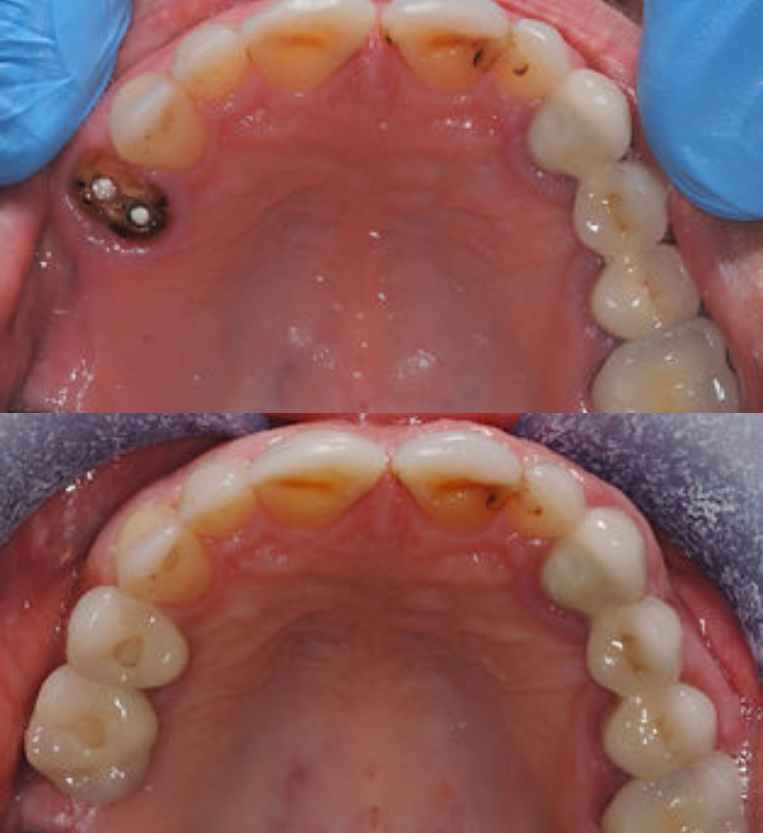 Multiple tooth dental implants before and after